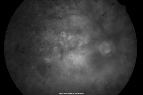Diabetic and Pseudophakic Cystoid Macular Edema Late FA - Leakage Macular and Nerve
56-year-old woman has diabetic retinopathy in both eyes and macular edema.  She is recently pseudophakic.  OD 20/80, OS 20/200.  
Keywords: cme;bdr;pseudophakic;laser;kenalog