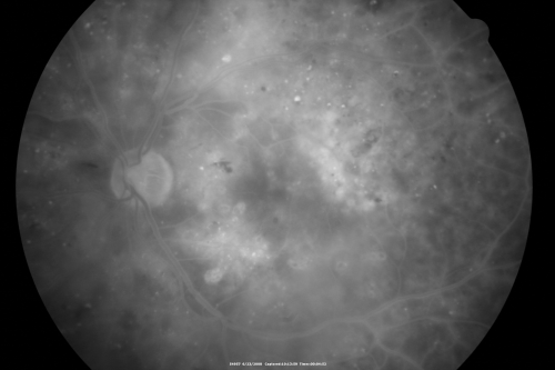 Diabetic and Pseudophakic Cystoid Macular Edema Late FA fellow Eye
56-year-old woman has diabetic retinopathy in both eyes and macular edema.  She is recently pseudophakic.  OD 20/80, OS 20/200.  
Keywords: cme;bdr;pseudophakic;laser;kenalog