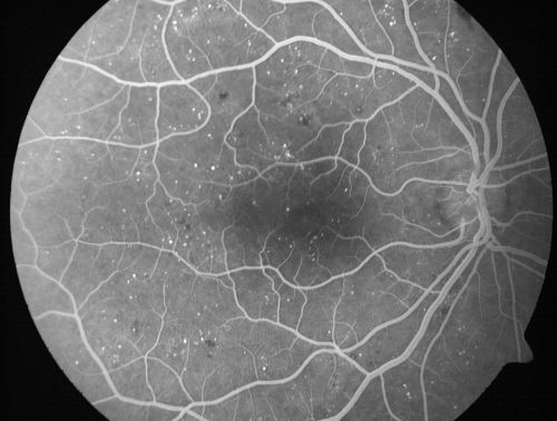 Mild Clinically Significant Diabetic Macular Edema
58-year-old woman diabetic for 20 years who has diabetic macular edema in both eyes.  She has had waxing and waning edema in the past and I thought it might improve on its own but it did not.  She notices her vision is still a little hazy.

VISUAL ACUITY: Vision OD is 20/30, OS is 20/25. 
