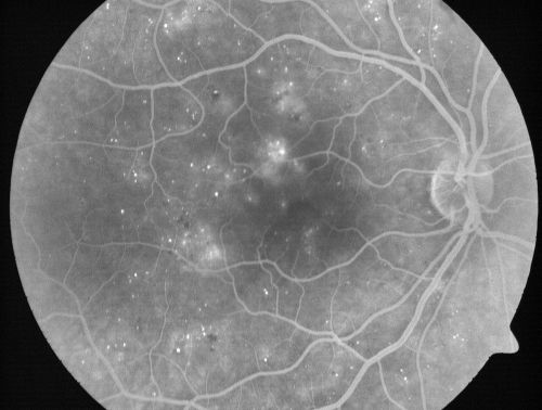 Mild Clinically Significant Diabetic Macular Edema
58-year-old woman diabetic for 20 years who has diabetic macular edema in both eyes.  She has had waxing and waning edema in the past and I thought it might improve on its own but it did not.  She notices her vision is still a little hazy.

VISUAL ACUITY: Vision OD is 20/30, OS is 20/25. 

