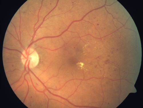 Mild Clinically Significant Diabetic Macular Edema
58-year-old woman diabetic for 20 years who has diabetic macular edema in both eyes.  She has had waxing and waning edema in the past and I thought it might improve on its own but it did not.  She notices her vision is still a little hazy.

VISUAL ACUITY: Vision OD is 20/30, OS is 20/25. 
