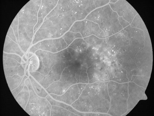 Mild Clinically Significant Diabetic Macular Edema
58-year-old woman diabetic for 20 years who has diabetic macular edema in both eyes.  She has had waxing and waning edema in the past and I thought it might improve on its own but it did not.  She notices her vision is still a little hazy.

VISUAL ACUITY: Vision OD is 20/30, OS is 20/25. 
