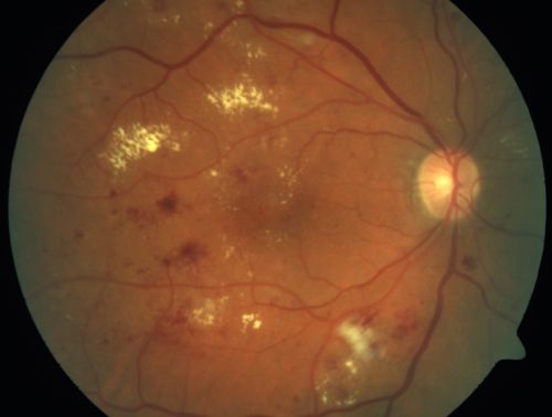 Diabetic Macular Edema and Hypertensive Retinopathy - Circinate Exudate (Ring Exudate) 
55-year-old woman diabetic for fifteen years and  high blood pressure, especially over the last few months.  She has had problems with nosebleeds, headaches, and there has been some difficulty bringing her blood pressure down.  She said now the blood pressure is under control but it was running 220/120 mmHg for some time.  Her vision in the right eye has been poor for four weeks with a spot in the central vision and both eyes have been blurred.

VISUAL ACUITY:  Vision OD is 20/160, OS is 20/60
