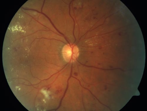 Diabetic Macular Edema and Hypertensive Retinopathy - Circinate Exudate (Ring Exudate) 
55-year-old woman diabetic for fifteen years and  high blood pressure, especially over the last few months.  She has had problems with nosebleeds, headaches, and there has been some difficulty bringing her blood pressure down.  She said now the blood pressure is under control but it was running 220/120 mmHg for some time.  Her vision in the right eye has been poor for four weeks with a spot in the central vision and both eyes have been blurred.

VISUAL ACUITY:  Vision OD is 20/160, OS is 20/60
