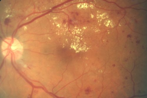 Diabetic Macular Edema and Hypertensive Retinopathy - Circinate Exudate (Ring Exudate) 
55-year-old woman diabetic for fifteen years and  high blood pressure, especially over the last few months.  She has had problems with nosebleeds, headaches, and there has been some difficulty bringing her blood pressure down.  She said now the blood pressure is under control but it was running 220/120 mmHg for some time.  Her vision in the right eye has been poor for four weeks with a spot in the central vision and both eyes have been blurred.

VISUAL ACUITY:  Vision OD is 20/160, OS is 20/60

