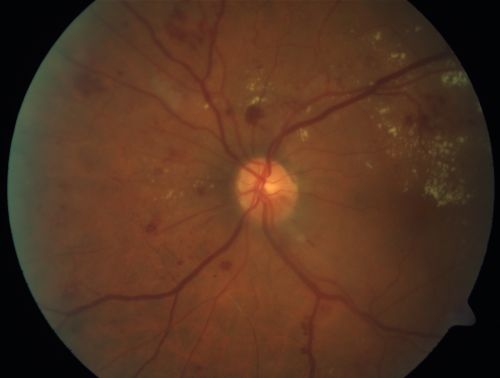 Diabetic Macular Edema and Hypertensive Retinopathy - Circinate Exudate (Ring Exudate) 
55-year-old woman diabetic for fifteen years and  high blood pressure, especially over the last few months.  She has had problems with nosebleeds, headaches, and there has been some difficulty bringing her blood pressure down.  She said now the blood pressure is under control but it was running 220/120 mmHg for some time.  Her vision in the right eye has been poor for four weeks with a spot in the central vision and both eyes have been blurred.

VISUAL ACUITY:  Vision OD is 20/160, OS is 20/60
