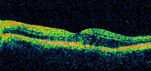 Diabetic Macular Edema and Hypertensive Retinopathy - Circinate Exudate (Ring Exudate) 
55-year-old woman diabetic for fifteen years and  high blood pressure, especially over the last few months.  She has had problems with nosebleeds, headaches, and there has been some difficulty bringing her blood pressure down.  She said now the blood pressure is under control but it was running 220/120 mmHg for some time.  Her vision in the right eye has been poor for four weeks with a spot in the central vision and both eyes have been blurred.

VISUAL ACUITY:  Vision OD is 20/160, OS is 20/60
