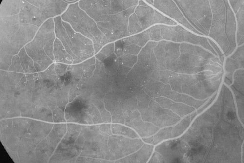 Diabetic Macular Edema and Hypertensive Retinopathy - Circinate Exudate (Ring Exudate) 
55-year-old woman diabetic for fifteen years and  high blood pressure, especially over the last few months.  She has had problems with nosebleeds, headaches, and there has been some difficulty bringing her blood pressure down.  She said now the blood pressure is under control but it was running 220/120 mmHg for some time.  Her vision in the right eye has been poor for four weeks with a spot in the central vision and both eyes have been blurred.

VISUAL ACUITY:  Vision OD is 20/160, OS is 20/60
