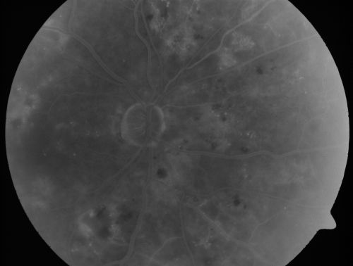 Diabetic Macular Edema and Hypertensive Retinopathy - Circinate Exudate (Ring Exudate) 
55-year-old woman diabetic for fifteen years and  high blood pressure, especially over the last few months.  She has had problems with nosebleeds, headaches, and there has been some difficulty bringing her blood pressure down.  She said now the blood pressure is under control but it was running 220/120 mmHg for some time.  Her vision in the right eye has been poor for four weeks with a spot in the central vision and both eyes have been blurred.

VISUAL ACUITY:  Vision OD is 20/160, OS is 20/60

