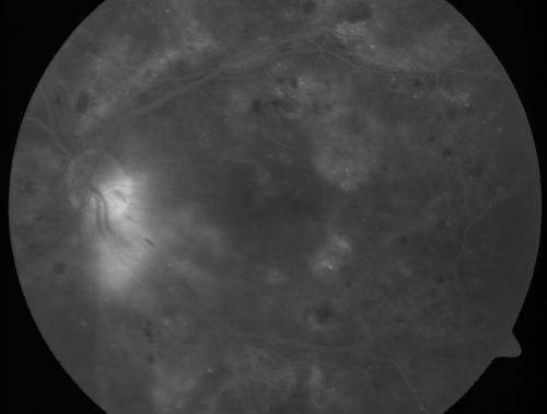 Diabetic Macular Edema and Hypertensive Retinopathy - Circinate Exudate (Ring Exudate) 
55-year-old woman diabetic for fifteen years and  high blood pressure, especially over the last few months.  She has had problems with nosebleeds, headaches, and there has been some difficulty bringing her blood pressure down.  She said now the blood pressure is under control but it was running 220/120 mmHg for some time.  Her vision in the right eye has been poor for four weeks with a spot in the central vision and both eyes have been blurred.

VISUAL ACUITY:  Vision OD is 20/160, OS is 20/60
