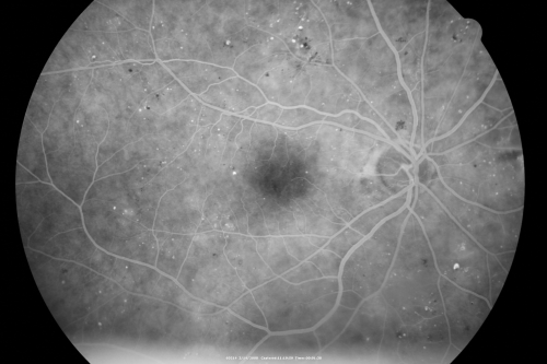 Diabetic Macular Edema Left Eye - Pre Laser
82-year-old woman diabetic for many years, last eye exam 5 years ago with gradual vision loss.  OD 20/60, OS 20/70.  IOP:  OD 16, OS 17.

