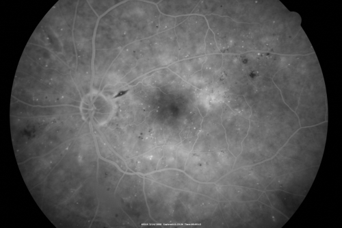 Diabetic Macular Edema Left Eye - Pre Laser
82-year-old woman diabetic for many years, last eye exam 5 years ago with gradual vision loss.  OD 20/60, OS 20/70.  IOP:  OD 16, OS 17.

