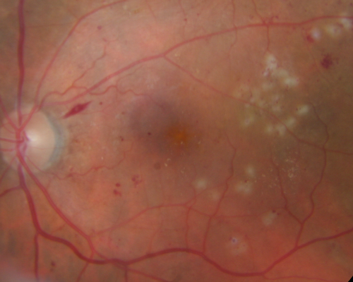 Diabetic Macular Edema Left Eye - Post Laser
82-year-old woman diabetic for many years, last eye exam 5 years ago with gradual vision loss.  OD 20/60, OS 20/70.  IOP:  OD 16, OS 17.

Keywords: best diabetic