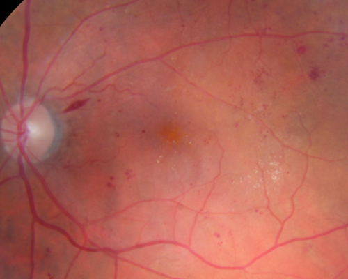 Diabetic Macular Edema Left Eye - Pre Laser
82-year-old woman diabetic for many years, last eye exam 5 years ago with gradual vision loss.  OD 20/60, OS 20/70.  IOP:  OD 16, OS 17.

