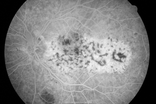 Bilateral Diffuse Uveal Melanocytic Proliferation - BDUMP - Paraneoplastic Syndrome
80-year-old man vision loss for one year.  He died about one year after these photos from Metastatic Poorly Differentiated Large Cell Carcinoma of unknown primary.  He was a smoker. 
Keywords: bdump;bilateral diffuse uveal melanocytic proliferation;pigmented