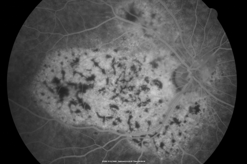 Bilateral Diffuse Uveal Melanocytic Proliferation - BDUMP - Paraneoplastic Syndrome
80-year-old man vision loss for one year.  He died about one year after these photos from Metastatic Poorly Differentiated Large Cell Carcinoma of unknown primary.  He was a smoker. 
Keywords: bdump;bilateral diffuse uveal melanocytic proliferation;pigmented