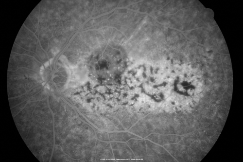 Bilateral Diffuse Uveal Melanocytic Proliferation - BDUMP - Paraneoplastic Syndrome
80-year-old man vision loss for one year.  He died about one year after these photos from Metastatic Poorly Differentiated Large Cell Carcinoma of unknown primary.  He was a smoker. 
Keywords: bdump;bilateral diffuse uveal melanocytic proliferation;pigmented