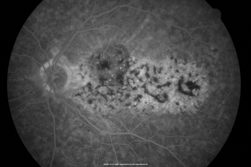 Bilateral Diffuse Uveal Melanocytic Proliferation - BDUMP - Paraneoplastic Syndrome
80-year-old man vision loss for one year.  He died about one year after these photos from Metastatic Poorly Differentiated Large Cell Carcinoma of unknown primary.  He was a smoker. 
Keywords: bdump;bilateral diffuse uveal melanocytic proliferation;pigmented