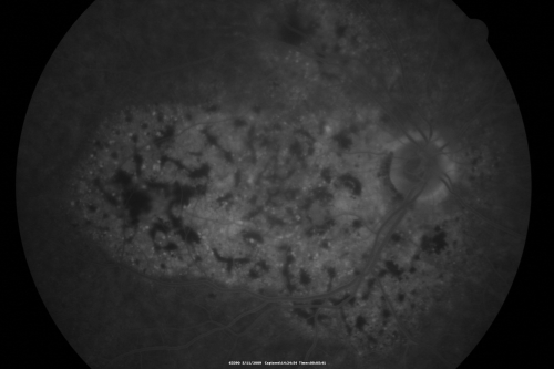 Bilateral Diffuse Uveal Melanocytic Proliferation - BDUMP - Paraneoplastic Syndrome
80-year-old man vision loss for one year.  He died about one year after these photos from Metastatic Poorly Differentiated Large Cell Carcinoma of unknown primary.  He was a smoker. 
Keywords: bdump;bilateral diffuse uveal melanocytic proliferation;pigmented