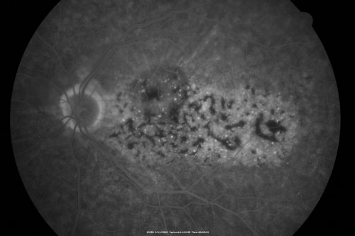 Bilateral Diffuse Uveal Melanocytic Proliferation - BDUMP - Paraneoplastic Syndrome
80-year-old man vision loss for one year.  He died about one year after these photos from Metastatic Poorly Differentiated Large Cell Carcinoma of unknown primary.  He was a smoker. 
Keywords: bdump;bilateral diffuse uveal melanocytic proliferation;pigmented