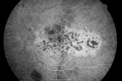 Bilateral Diffuse Uveal Melanocytic Proliferation - BDUMP - Paraneoplastic Syndrome
80-year-old man vision loss for one year.  He died about one year after these photos from Metastatic Poorly Differentiated Large Cell Carcinoma of unknown primary.  He was a smoker. 
Keywords: bdump;bilateral diffuse uveal melanocytic proliferation;pigmented