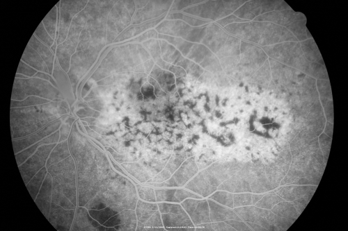 Bilateral Diffuse Uveal Melanocytic Proliferation - BDUMP - Paraneoplastic Syndrome
80-year-old man vision loss for one year.  He died about one year after these photos from Metastatic Poorly Differentiated Large Cell Carcinoma of unknown primary.  He was a smoker. 
Keywords: bdump;bilateral diffuse uveal melanocytic proliferation;pigmented