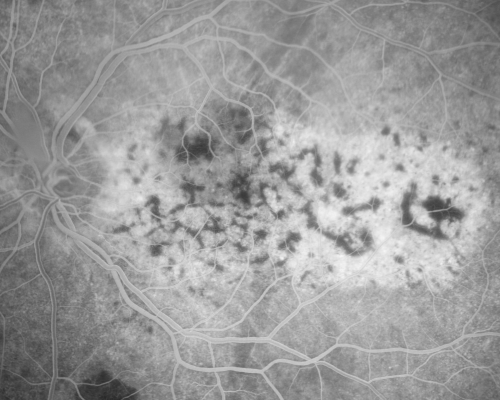 Bilateral Diffuse Uveal Melanocytic Proliferation - BDUMP - Paraneoplastic Syndrome
80-year-old man vision loss for one year.  He died about one year after these photos from Metastatic Poorly Differentiated Large Cell Carcinoma of unknown primary.  He was a smoker. 
Keywords: v