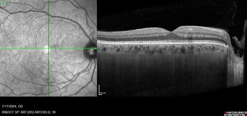 Bear tracks (and diabetic retinopathy)
48 year old female with bear tracks in her retina and NPDR.
