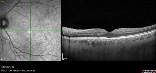 Bear tracks (and diabetic retinopathy)
48 year old female with bear tracks in her retina and NPDR.
