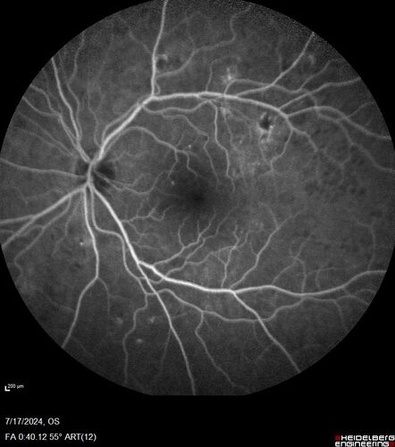 Bear tracks (and diabetic retinopathy)
48 year old female with bear tracks in her retina and NPDR.
