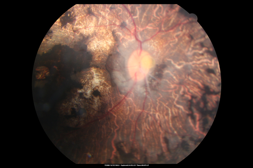 Retinitis Pigmentosa - Autosomal Dominant - Vision Loss at Young Age - Fundus Photo
 54-year-old woman has autosomal dominant retinitis pigmentosa.  Her mother and grandmother both had it and she has one son who has it and one daughter who doesnâ€™t.  She also has a sister with it.  She lost vision since she was younger.  She had cataract surgery done in January and February of this year.  She has been seeing unusual flashing lights throughout the periphery and central vision for about the last year or two.  

VISUAL ACUITY:  OD 20/160,  OS 20/160
