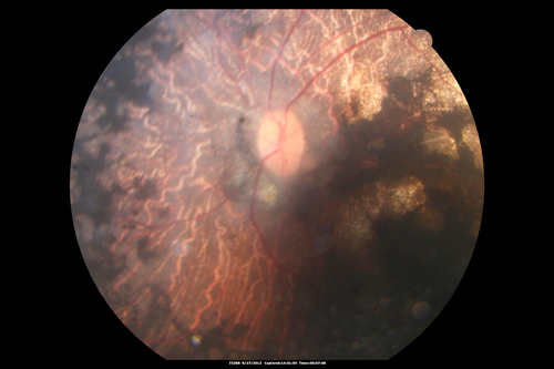 Retinitis Pigmentosa - Autosomal Dominant - Vision Loss at Young Age - Fundus Photo
 54-year-old woman has autosomal dominant retinitis pigmentosa.  Her mother and grandmother both had it and she has one son who has it and one daughter who doesnâ€™t.  She also has a sister with it.  She lost vision since she was younger.  She had cataract surgery done in January and February of this year.  She has been seeing unusual flashing lights throughout the periphery and central vision for about the last year or two.  

VISUAL ACUITY:  OD 20/160,  OS 20/160
