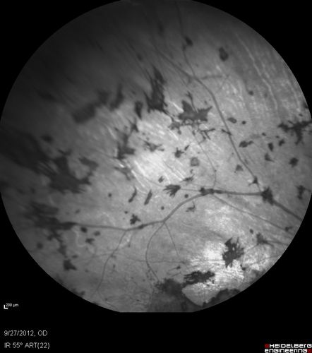 Retinitis Pigmentosa - Autosomal Dominant - Vision Loss at Young Age - Infrared
 54-year-old woman has autosomal dominant retinitis pigmentosa.  Her mother and grandmother both had it and she has one son who has it and one daughter who doesnâ€™t.  She also has a sister with it.  She lost vision since she was younger.  She had cataract surgery done in January and February of this year.  She has been seeing unusual flashing lights throughout the periphery and central vision for about the last year or two.  

VISUAL ACUITY:  OD 20/160,  OS 20/160
