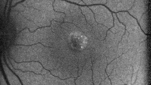 Best Disease
30 year old man vision 20/40 OD, 20/20 OS - strong family history
