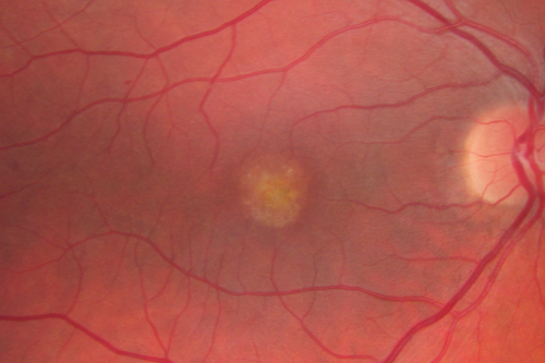Best Disease - Color Fundus Photo
