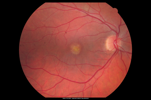 Best Disease - Color Fundus Photo
