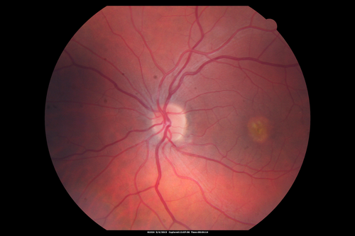 Best Disease - Color Fundus Photo
