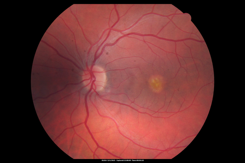 Best Disease - Color Fundus Photo
