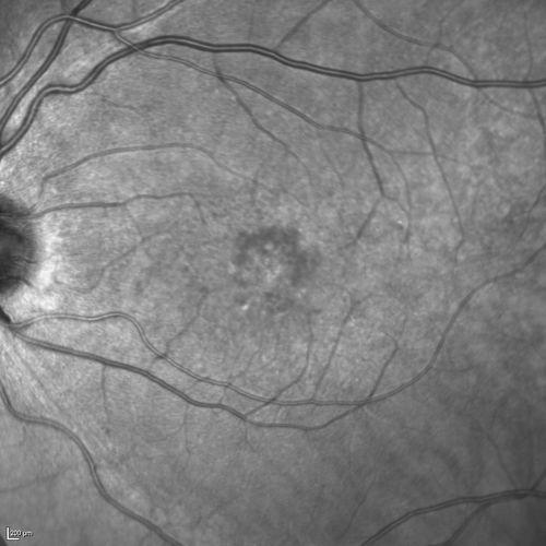 Best Disease Infra Red
