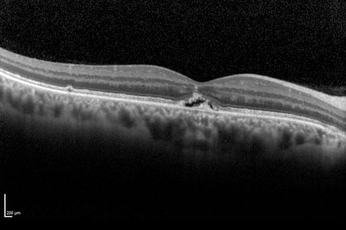 Best Disease - SD OCT Line Scan
