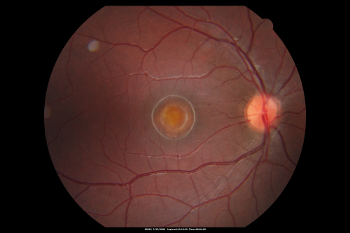 Best Disease - Left Eye Treated Previously, Elsewhere, with PDT and Avastin
11-year-old has Bestâ€™s disease that runs in his family on his mothers side. At another retina specialists office, he had photodynamic laser in April of 2009 and Avastin subsequently in June of 2009.  Unfortunately with that his vision is substantially declining.  OD 20/30,  OS 20/100
Keywords: best;dystrophy;pdt;avastin