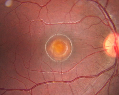 Best Disease - Left Eye Treated Previously, Elsewhere, with PDT and Avastin
11-year-old has Bestâ€™s disease that runs in his family on his mothers side. At another retina specialists office, he had photodynamic laser in April of 2009 and Avastin subsequently in June of 2009.  Unfortunately with that his vision is substantially declining.  OD 20/30,  OS 20/100
Keywords: best;dystrophy;pdt;avastin;december2011