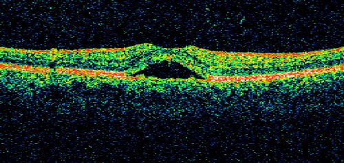 Best Disease - Left Eye Treated Previously, Elsewhere, with PDT and Avastin
11-year-old has Bestâ€™s disease that runs in his family on his mothers side. At another retina specialists office, he had photodynamic laser in April of 2009 and Avastin subsequently in June of 2009.  Unfortunately with that his vision is substantially declining.  OD 20/30,  OS 20/100
Keywords: best;dystrophy;pdt;avastin