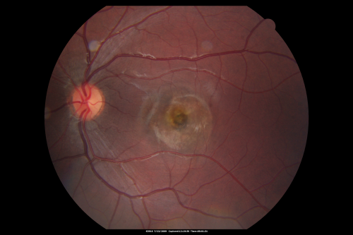 Best Disease - Left Eye Treated Previously, Elsewhere, with PDT and Avastin
11-year-old has Bestâ€™s disease that runs in his family on his mothers side. At another retina specialists office, he had photodynamic laser in April of 2009 and Avastin subsequently in June of 2009.  Unfortunately with that his vision is substantially declining.  OD 20/30,  OS 20/100
Keywords: best;dystrophy;pdt;avastin