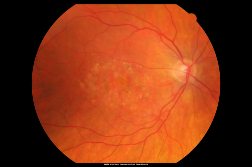 Best Disease for 30 Years - 20/50 Vision both eyes - 61 Year Old Woman
61-year-old woman was diagnosed with Bestâ€™s disease about 30 years ago.  She and her many family members were tested, both at the VA Hospital and then at USF.   OD 20/50, OS 20/50
