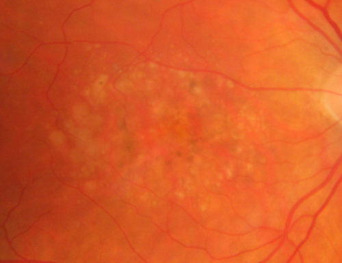 Best Disease for 30 Years - 20/50 Vision both eyes - 61 Year Old Woman
61-year-old woman was diagnosed with Bestâ€™s disease about 30 years ago.  She and her many family members were tested, both at the VA Hospital and then at USF.   OD 20/50, OS 20/50
