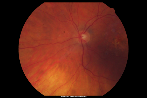 Best Disease for 30 Years - 20/50 Vision both eyes - 61 Year Old Woman
61-year-old woman was diagnosed with Bestâ€™s disease about 30 years ago.  She and her many family members were tested, both at the VA Hospital and then at USF.   OD 20/50, OS 20/50
