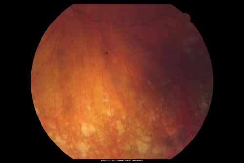 Best Disease for 30 Years - 20/50 Vision both eyes - 61 Year Old Woman
61-year-old woman was diagnosed with Bestâ€™s disease about 30 years ago.  She and her many family members were tested, both at the VA Hospital and then at USF.   OD 20/50, OS 20/50

