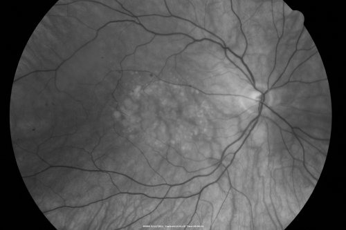 Best Disease for 30 Years - 20/50 Vision both eyes - 61 Year Old Woman
61-year-old woman was diagnosed with Bestâ€™s disease about 30 years ago.  She and her many family members were tested, both at the VA Hospital and then at USF.   OD 20/50, OS 20/50
