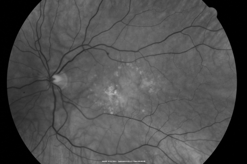 Best Disease for 30 Years - 20/50 Vision both eyes - 61 Year Old Woman
61-year-old woman was diagnosed with Bestâ€™s disease about 30 years ago.  She and her many family members were tested, both at the VA Hospital and then at USF.   OD 20/50, OS 20/50
